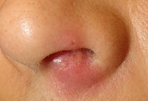 Чому болять прищі