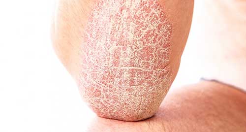 Чому болять прищі