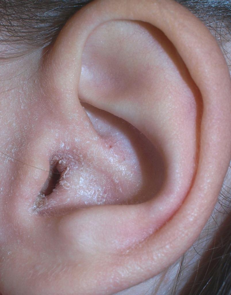 Чому мокне за вухом і як це лікувати