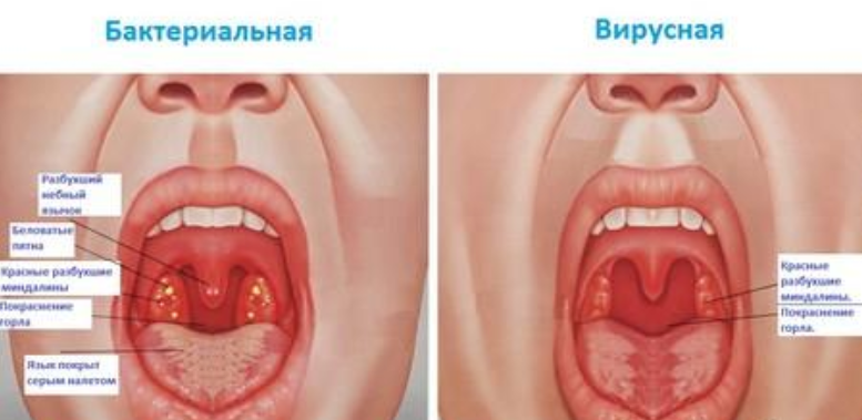 Чому можна полоскати дитині горло при ангіні