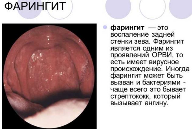 Чому можна полоскати горло при фарингіті в домашніх умовах