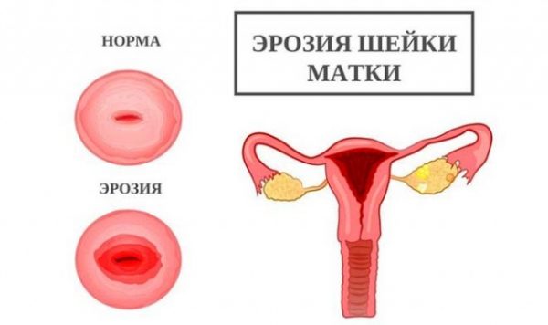 Чому після пологів може з’явитися ерозія шийки матки