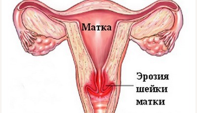 Чому після пологів може з’явитися ерозія шийки матки