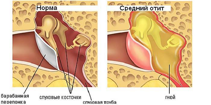 Чому у дитини болить вухо і як усунути цей симптом