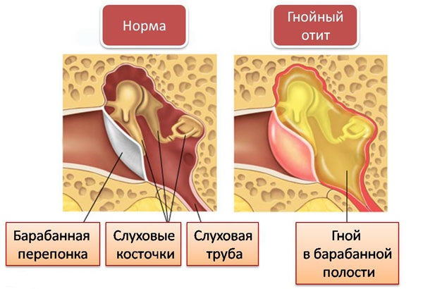 Чому у дитини тече гній з вуха і що робити
