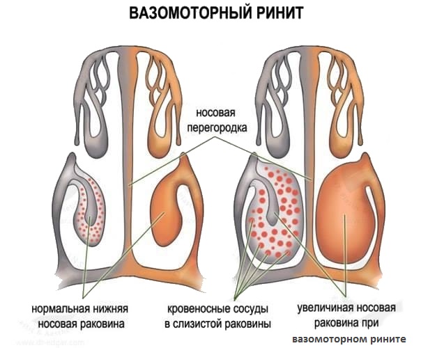 Чому в положенні лежачи закладає ніс і що робити? Чому закладає ніс у положенні лежачи? Причини і лікування.