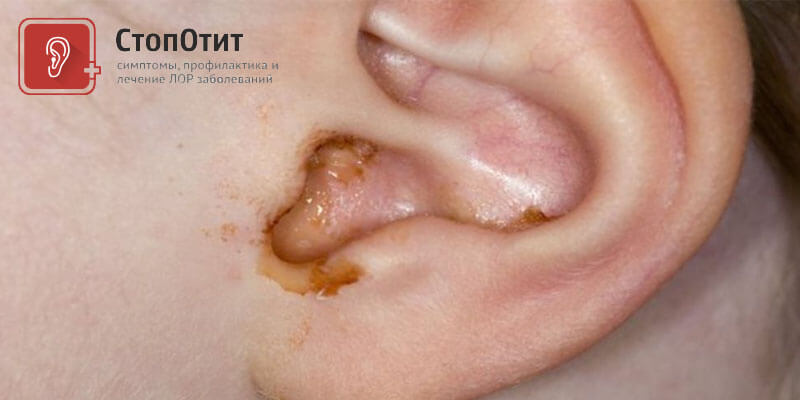 Чому виділяється багато сірки у вухах. Чому у вухах дитини накопичується багато сірки? Видалення вушної сірки Чому виділяється багато сірки у вухах. Чому у вухах дитини накопичується багато сірки? Видалення вушної сірки