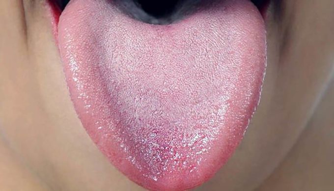 Чому виникає білий наліт на язиці