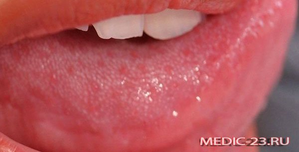 Чому виникає білий наліт на язиці