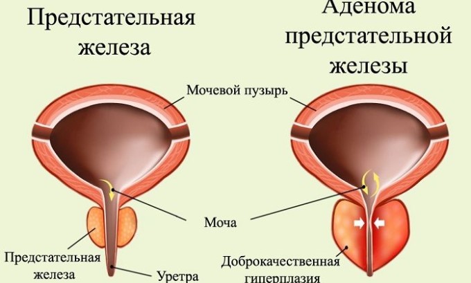 Чому виникає часте сечовипускання у чоловіків вночі
