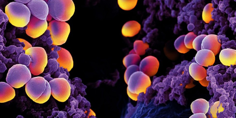 Чому з’являється золотистий стафілокок у вусі і як його лікувати. Стафілокок у вухах: симптоми та особливості лікування