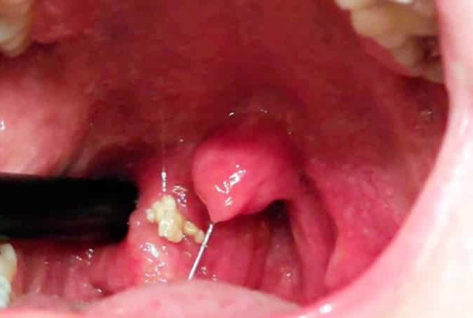 Чому з’являються білі грудки в горлі і як з цим боротися