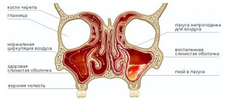 Чорна редька лікування гаймориту – Хвороби носа