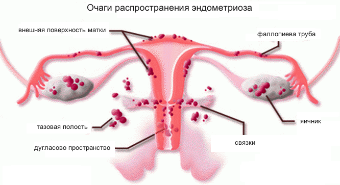Чотири стадії ретроцервикального ендометріозу