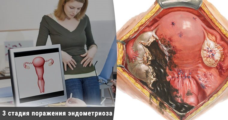 Чотири стадії ретроцервикального ендометріозу