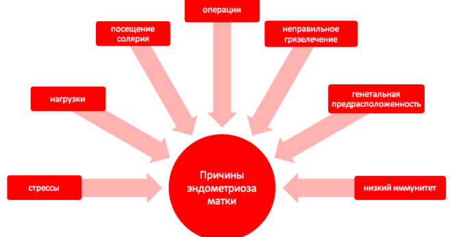 Чотири стадії ретроцервикального ендометріозу