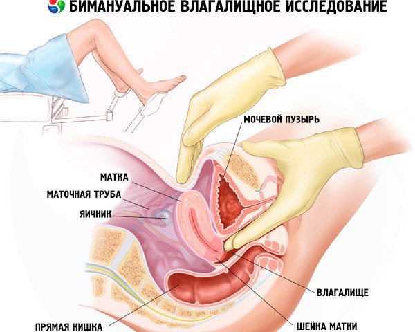 Чотири стадії ретроцервикального ендометріозу