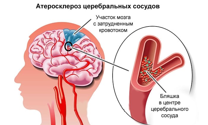 Цифран: інструкція із застосування антибіотика для дорослих і дітей, аналоги