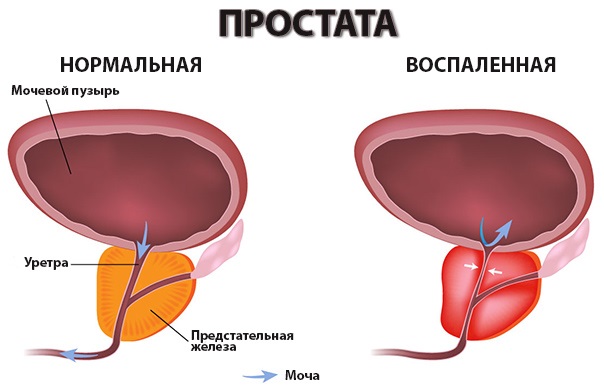 Ципролет застосування при гаймориті