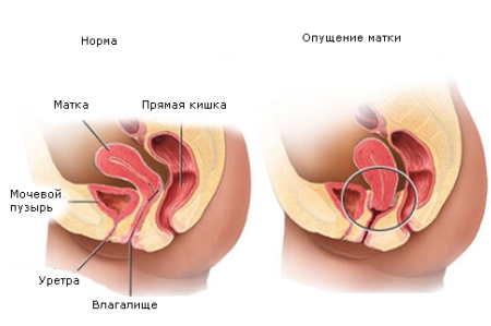 Цистоцеле випадання сечового міхура методики лікування і профілактики