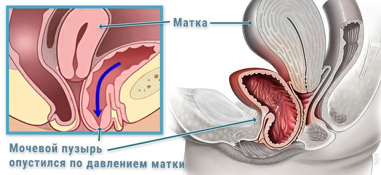 Цистоцеле випадання сечового міхура методики лікування і профілактики