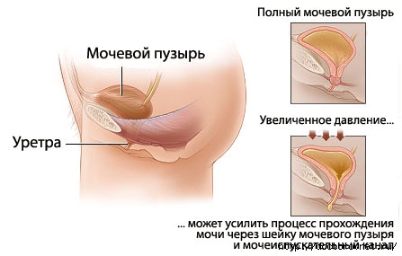 Цистоцеле випадання сечового міхура методики лікування і профілактики