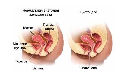 Цистоцеле випадання сечового міхура методики лікування і профілактики