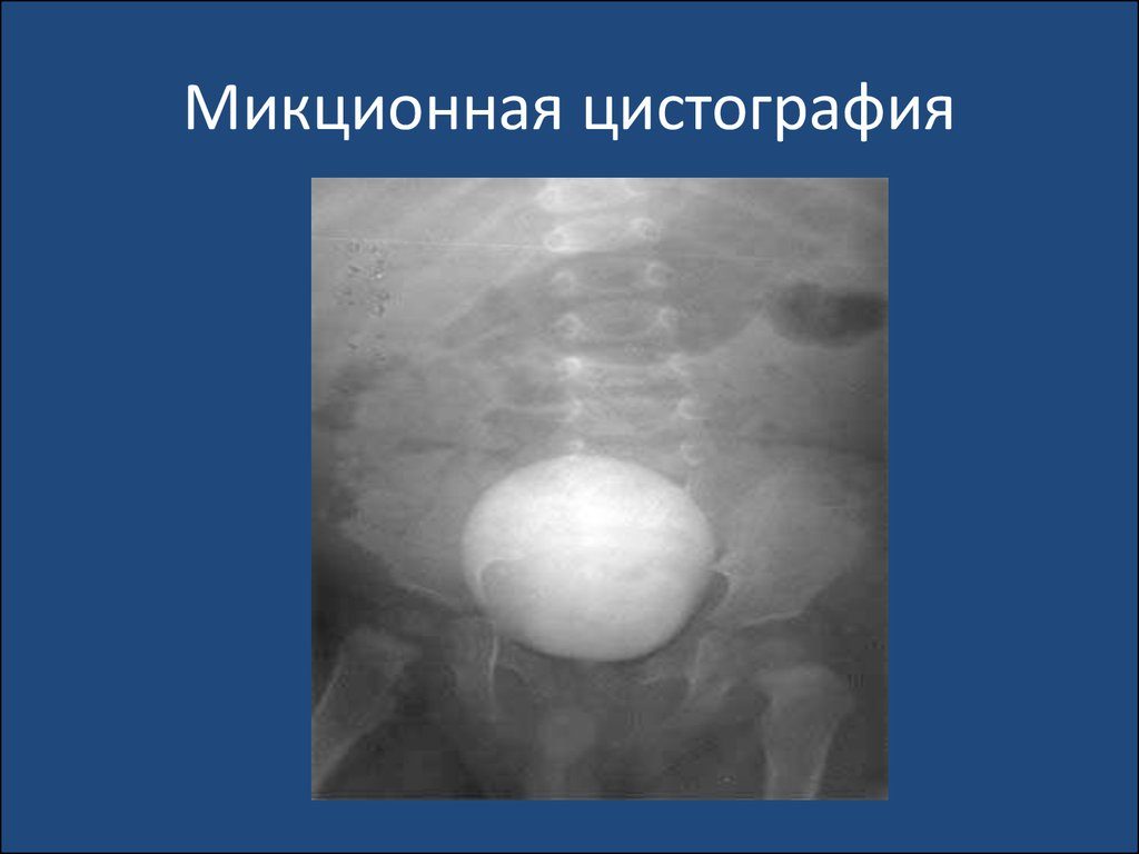Цистографія у дорослих і дітей