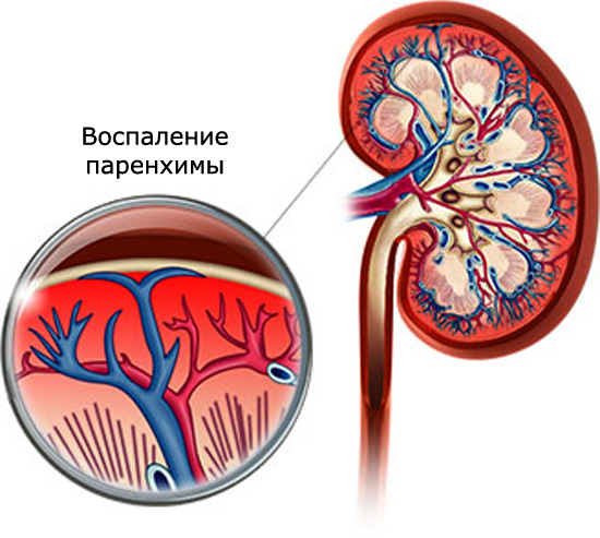Цистопієліт що це таке — Нирки
