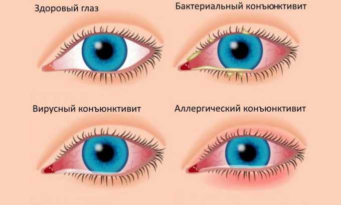 Дексаметазон очні краплі для дітей і дорослих