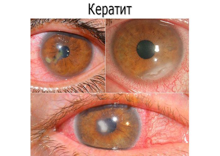 Дексаметазон очні краплі для дітей і дорослих