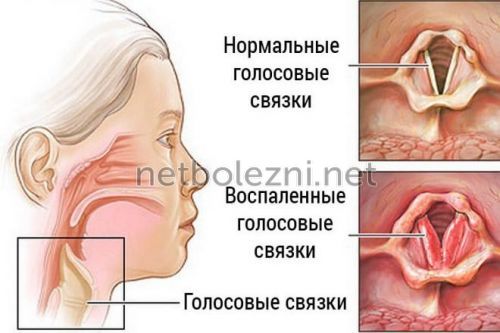 Дере в горлі і кашель як усунути причини