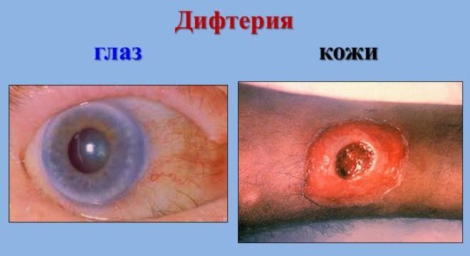 Дифтерія – симптоми, лікування, щеплення від дифтерії. Як убезпечити себе від недуги?