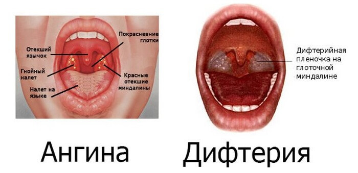 Дифтерія – симптоми, лікування, щеплення від дифтерії. Як убезпечити себе від недуги?