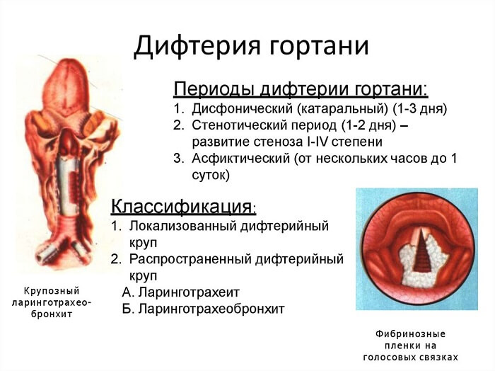 Дифтерія – симптоми, лікування, щеплення від дифтерії. Як убезпечити себе від недуги?