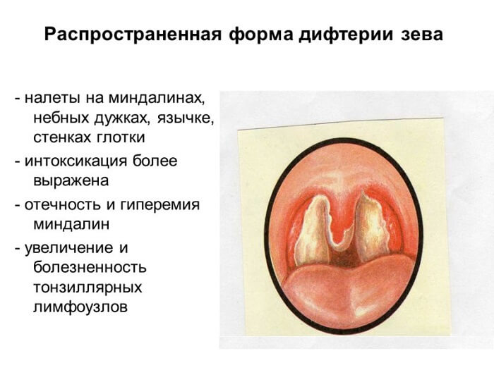 Дифтерія – симптоми, лікування, щеплення від дифтерії. Як убезпечити себе від недуги?