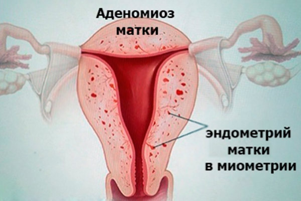 Дифузна форма аденоміозу матки