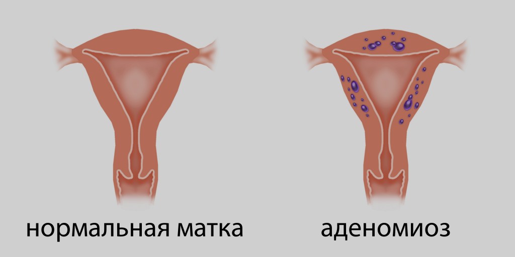 Дифузна форма аденоміозу матки