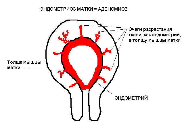 Дифузна форма аденоміозу матки