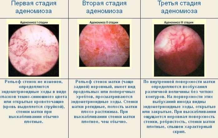 Дифузна форма аденоміозу матки