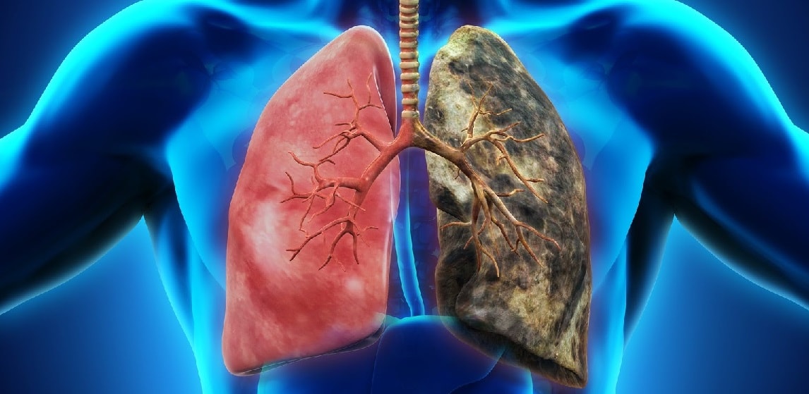 Дифузний пневмосклероз легень: що це таке і як лікувати