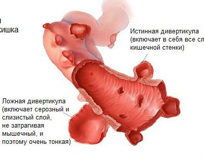 Дивертикули сечового міхура – що це таке?