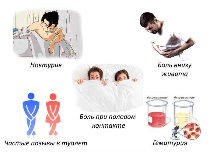 Дивертикули сечового міхура – що це таке?