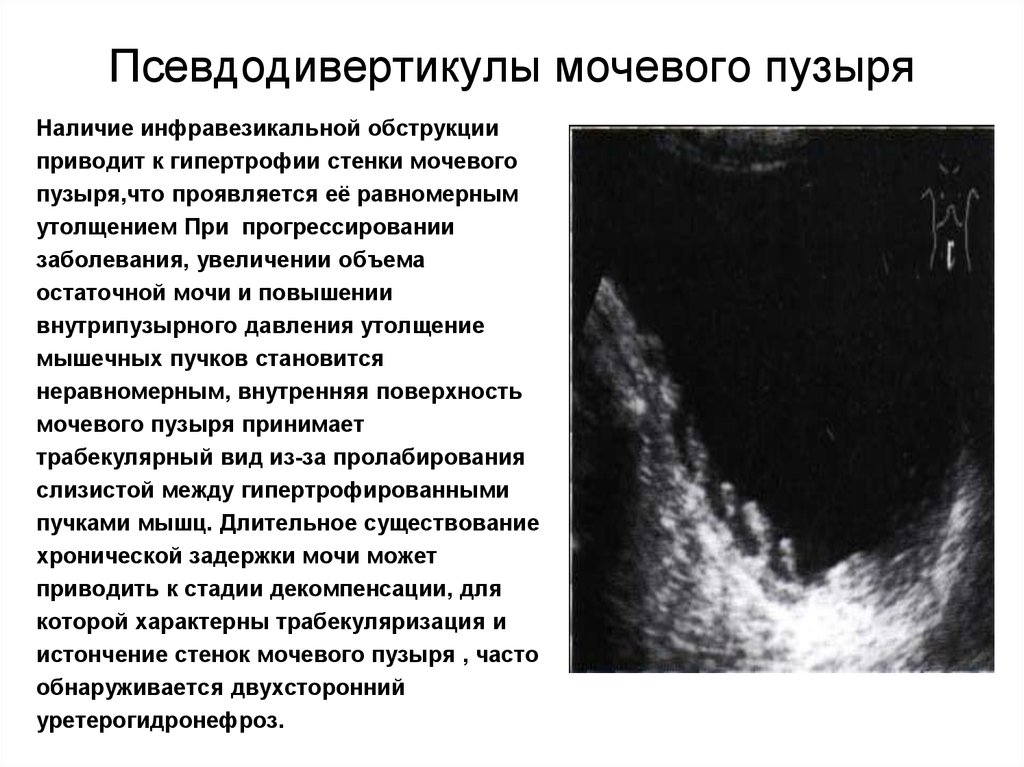 Дивертикули сечового міхура – що це таке?