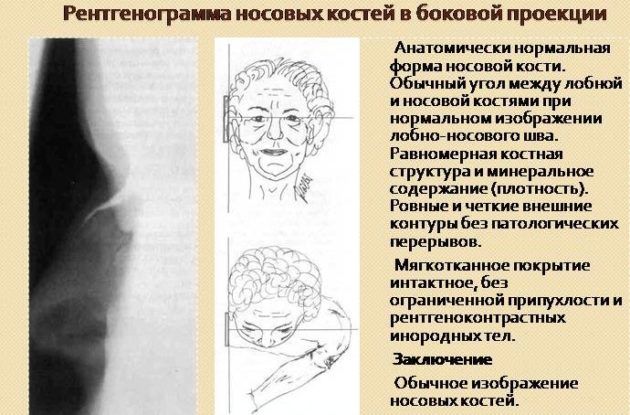 Для чого необхідний рентген гайморових пазух і як виглядає гайморит на знімку