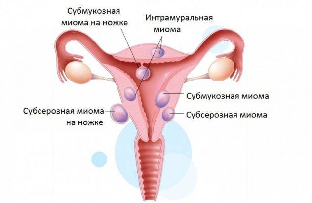 Для чого жінку вводять в стан штучної менопаузи і як не вийти