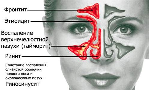 До чого може призвести фронтит. Симптоми і лікування фронтита: які ліки пити при фронтиті? Причини появи фронтиту