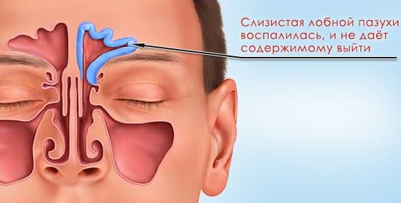 До чого може призвести фронтит. Симптоми і лікування фронтита: які ліки пити при фронтиті? Причини появи фронтиту