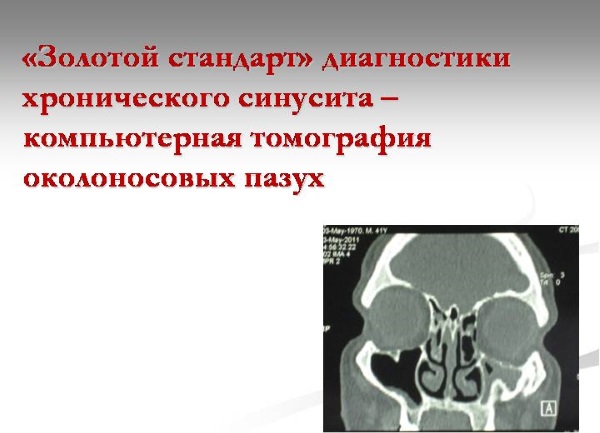До чого може призвести фронтит. Симптоми і лікування фронтита: які ліки пити при фронтиті? Причини появи фронтиту