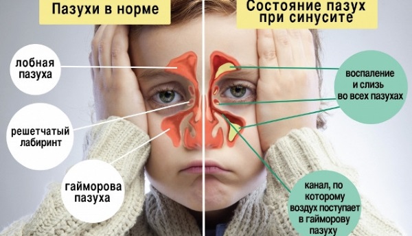 До чого може призвести фронтит. Симптоми і лікування фронтита: які ліки пити при фронтиті? Причини появи фронтиту